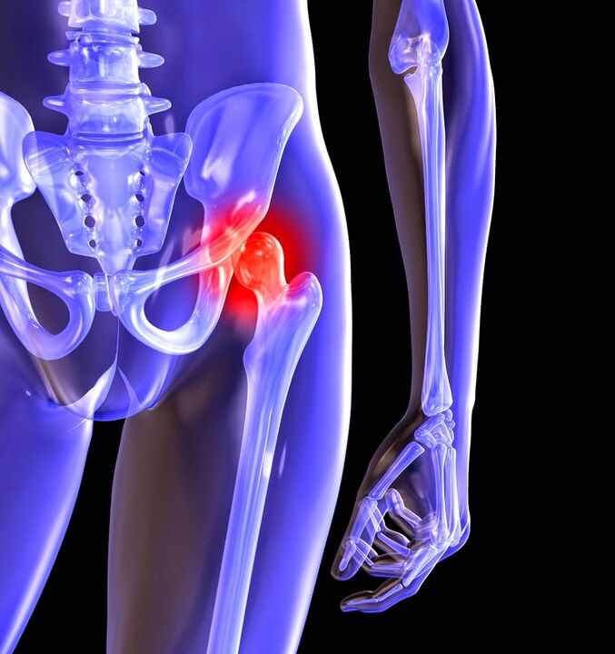 Deformed joints of the hip joint