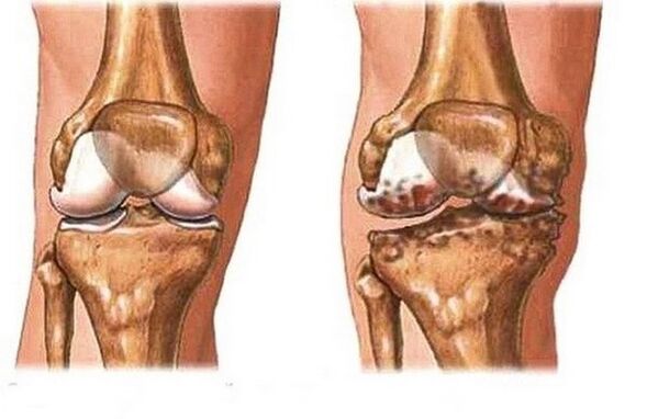 Healthy and sore joints