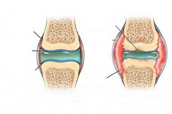 The process of joint deformation