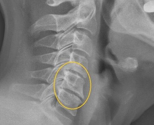 Osteochondral bone marrow disease on X-ray