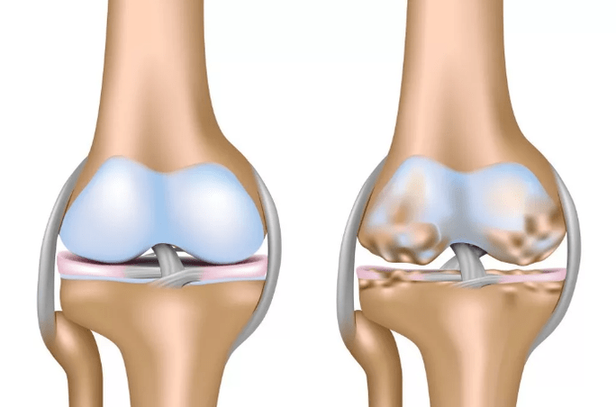 Deformed knee joints