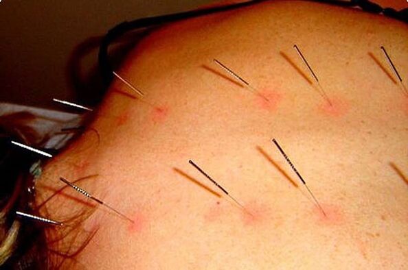 Acupuncture - a treatment for cervical osteochondrosis