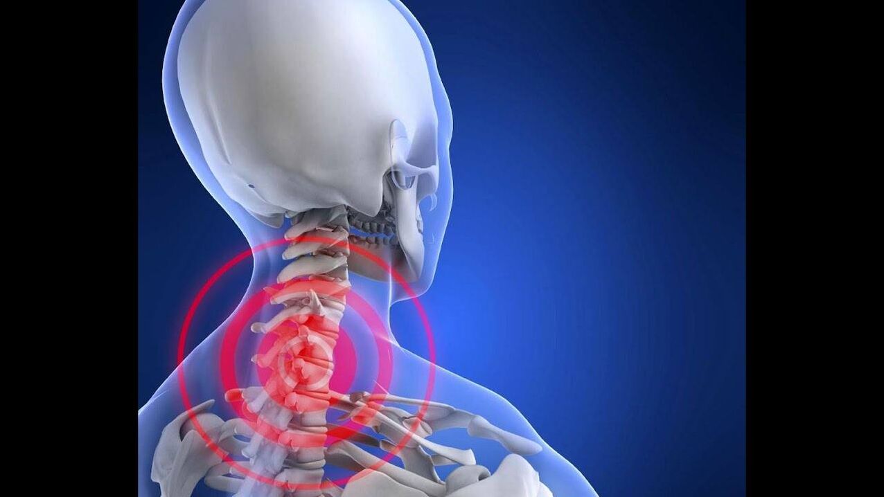 cervical osteochondrosis