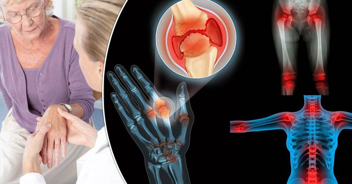 What is Arthropathy